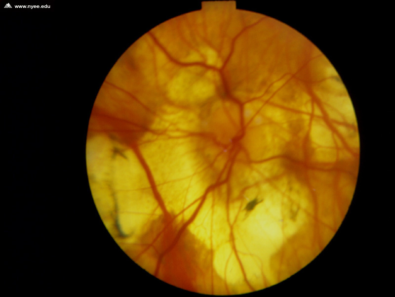 High Myopia with Posterior Staphyloma NYEE